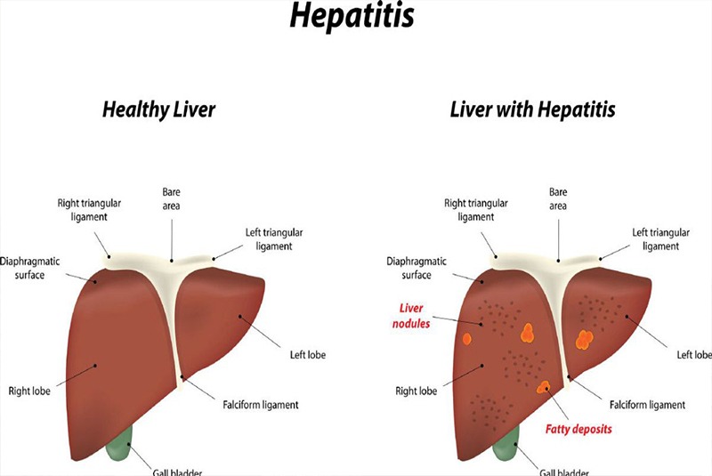 हेपाटाइटिसका बिरामी बढे
