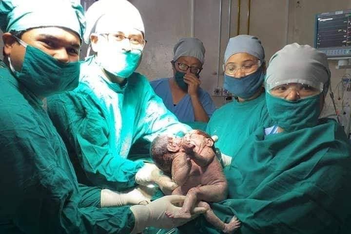 पेट र कलेजाे जाेडिएका जुम्ल्याहाकाे मृत्यु