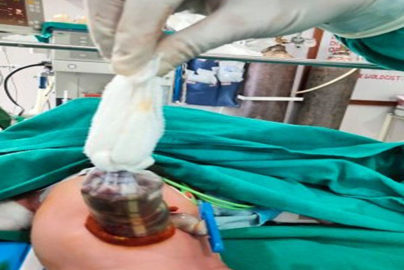 ईशान बाल अस्पतालमा गरियो जन्मिँदै आन्द्रा बाहिर भएको शिशुको जटिल शल्यक्रिया